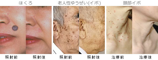 治療前、治療後の比較図