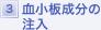 二重瞼