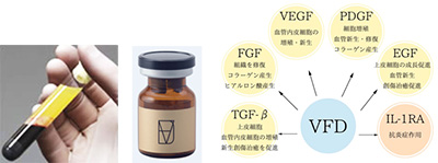 VFD療法　（PRP自己多血小板療法）　